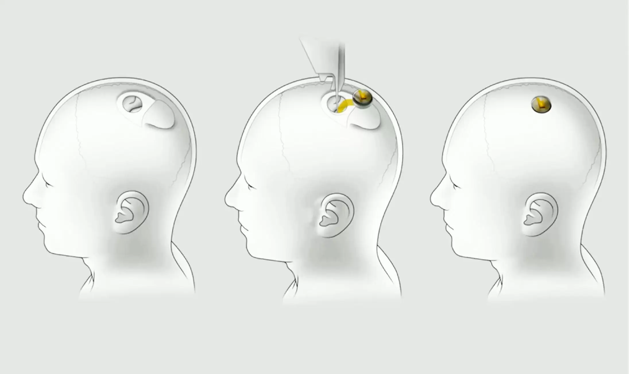 The neuralink – Into the mind of Elon Musk